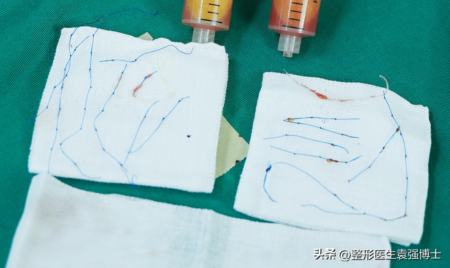 拉皮手术是整形的终极选择吗,整形大拉皮一般多少价格