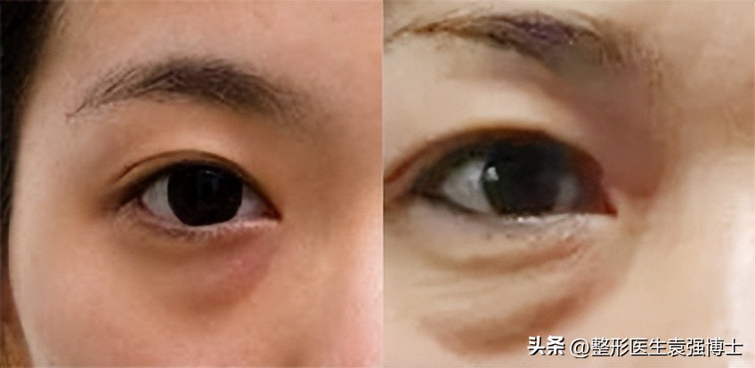 如何解决眼周衰老症状,眼周肌肤出现衰老怎么办