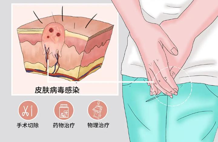 尖锐性湿疣治好了体内还有病毒吗,尖锐性湿疣多复发几次病毒会弱吗
