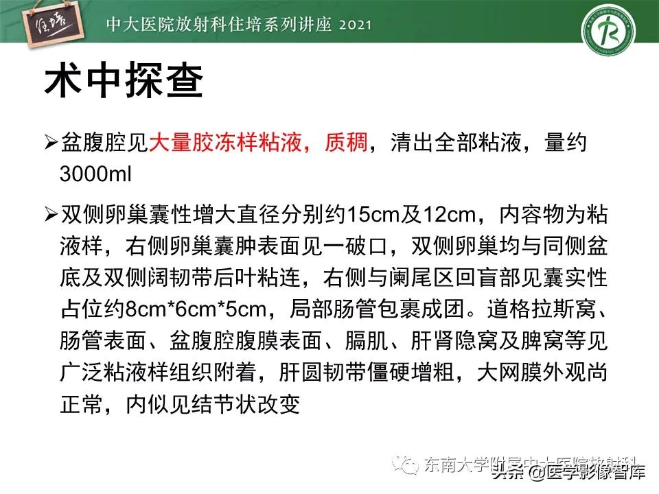 卵巢浆液性肿瘤的肉眼及镜下特征,卵巢原发性粘液性囊腺瘤