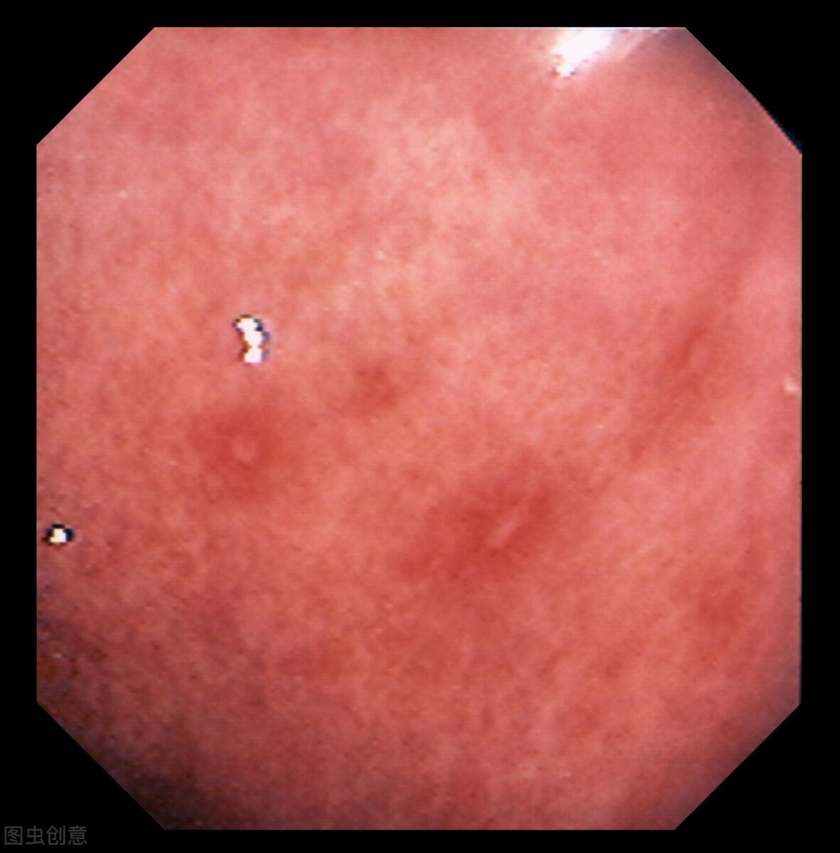 男子腹痛确疑病症,男子腹痛难忍医生怀疑