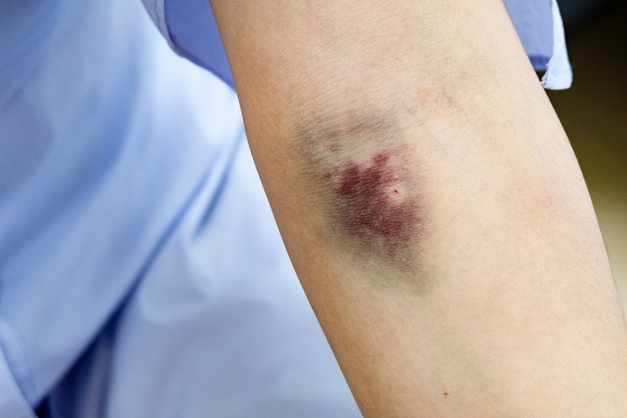 抽血完后手臂淤青又疼冷敷多久,孕妇抽血后手臂淤青怎么办