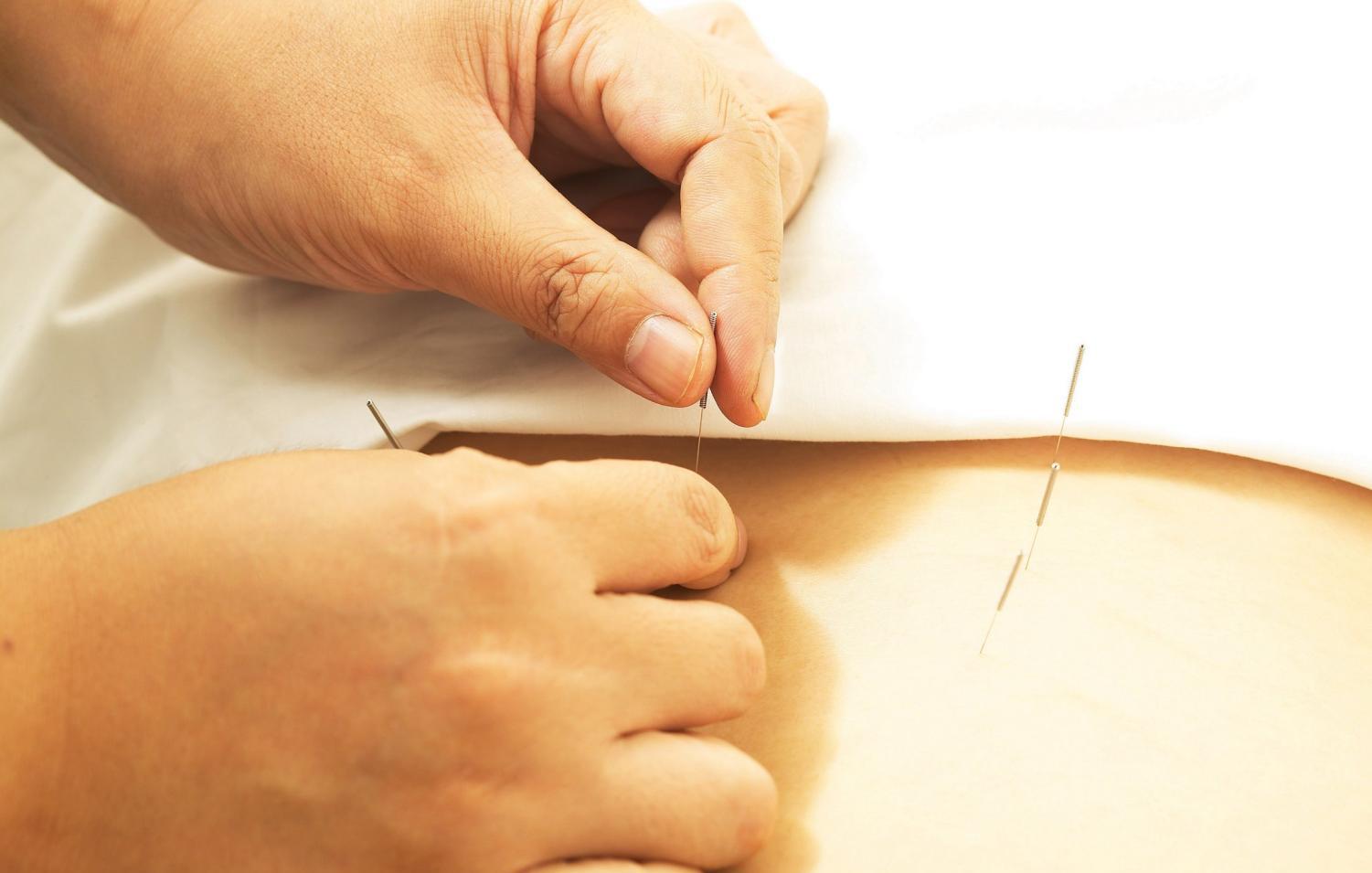 中医无痛治疗?芒针治疗中风后的寒热错杂型消化不良疗效相关研究