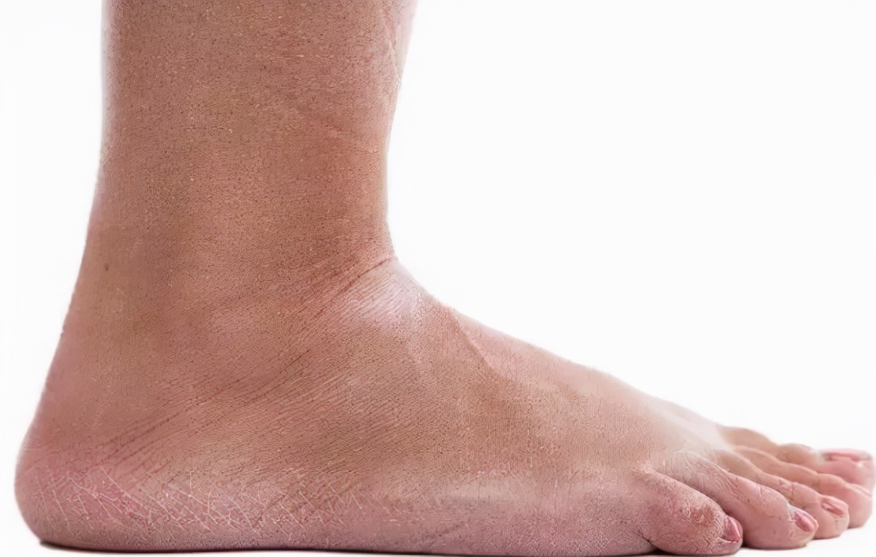 为什么有些人的脚后跟总开裂，可能是4种原因导致，附解决方法