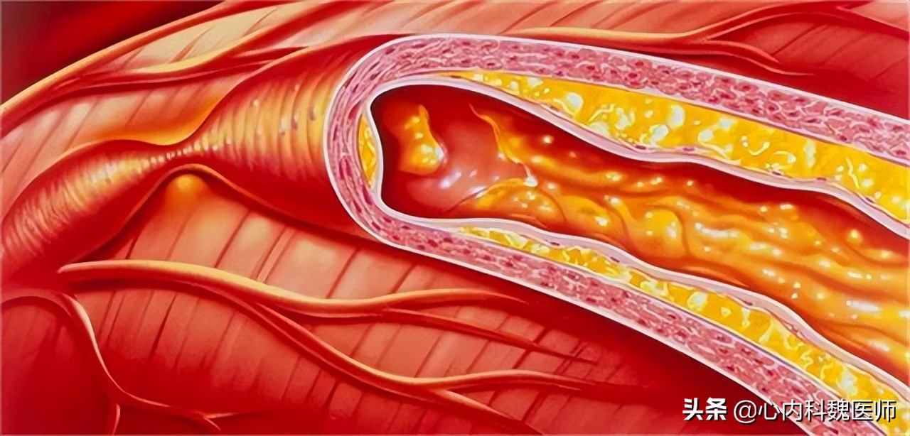 控制冠心病的药,治疗心血管疾病的药物哪个最好