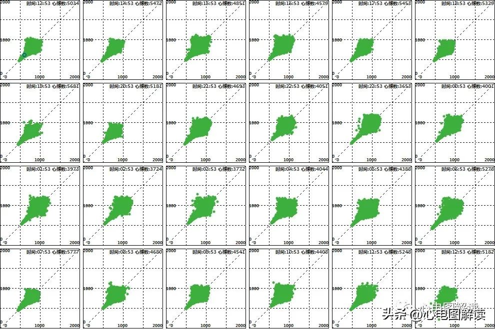 窦房结游走心律的临床意义,窦房结游走心律心电图特征