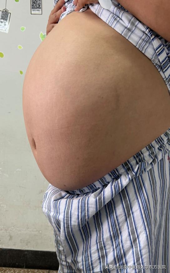 腹腔镜切除卵巢肿瘤,女子肚大似怀孕医生成功摘肿瘤