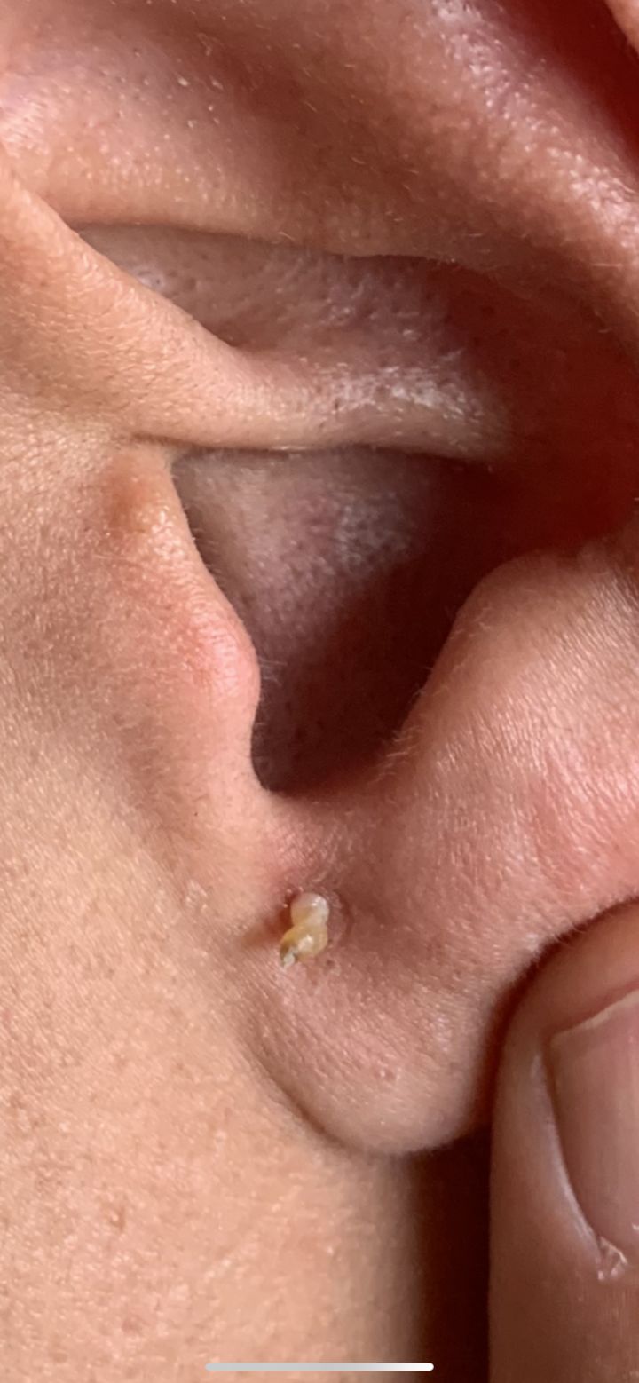 20年的黑头有多大,世界上最长的黑头到底有多长