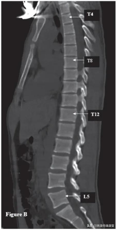 平背的成因,平背怎么造成的