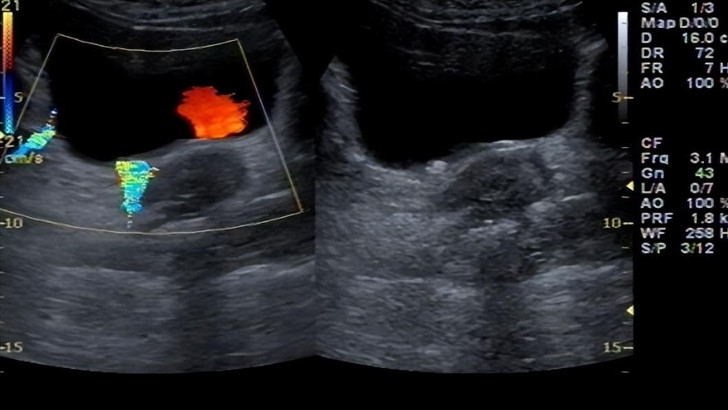 泌尿系统结石是什么原因导致的,泌尿系统结石的症状是什么