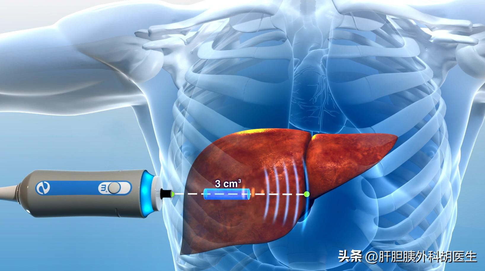 肝腹水肝硬化晚期症状表现有哪些,小孩肝硬化表现症状