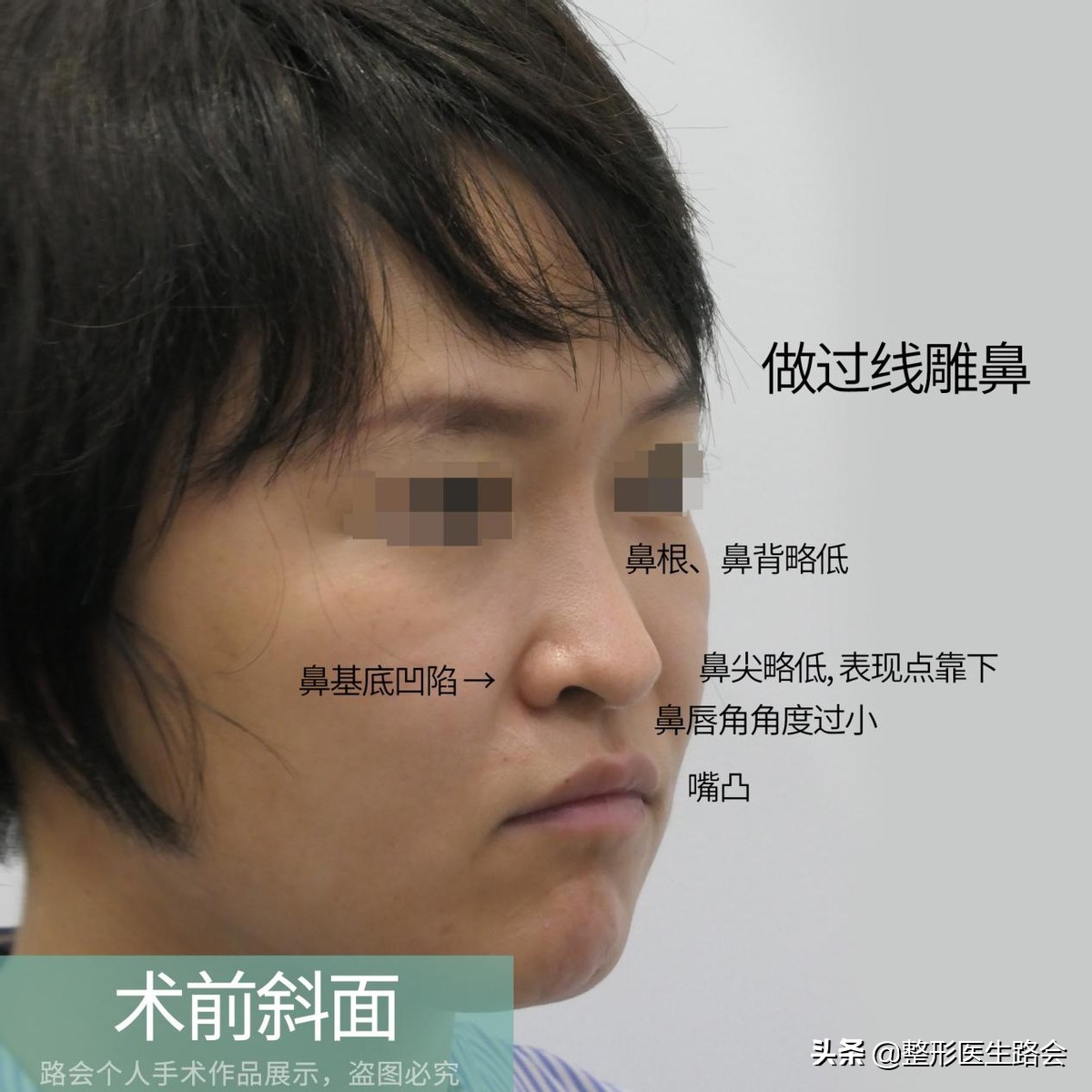 隆鼻三年后可以蹦极嘛,做了隆鼻到底可以蹦极吗