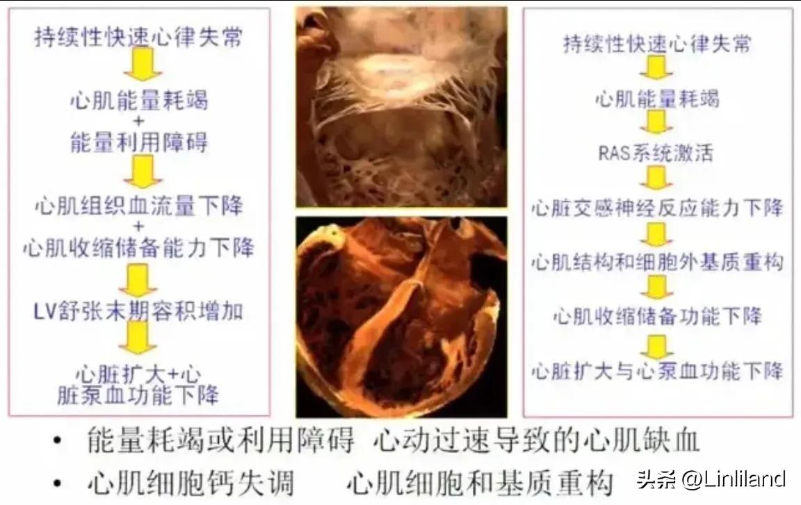 过速性房颤治疗,持续性房颤心动过速