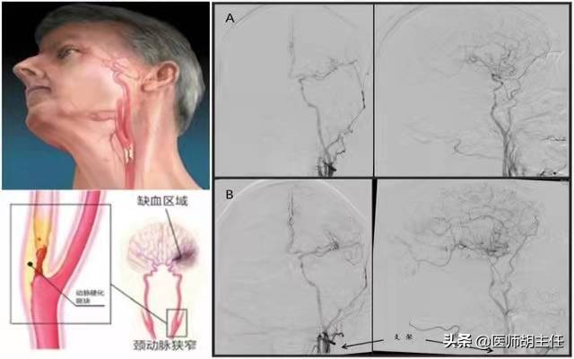 年轻人斑块是否能逆转,55岁大叔斑块消失