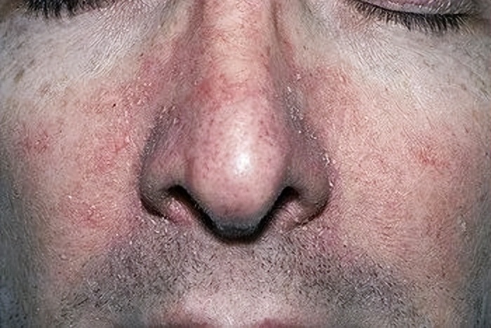 脂溢性皮炎吃维生素b2好还是b6好,油光满面最佳治疗方法