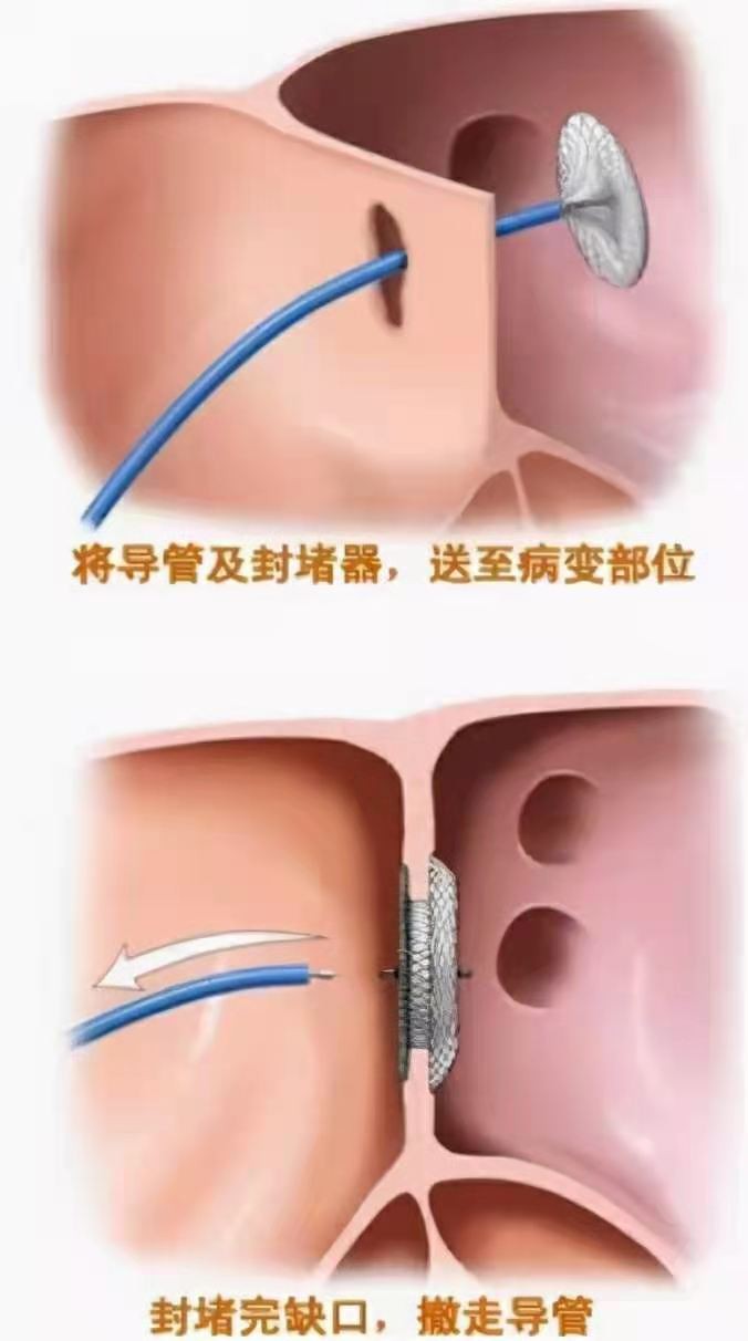 头痛竟需“医心”？！哈医大一院心内涂应锋团队经导管卵圆孔封堵术30分钟治愈患者10年偏头痛