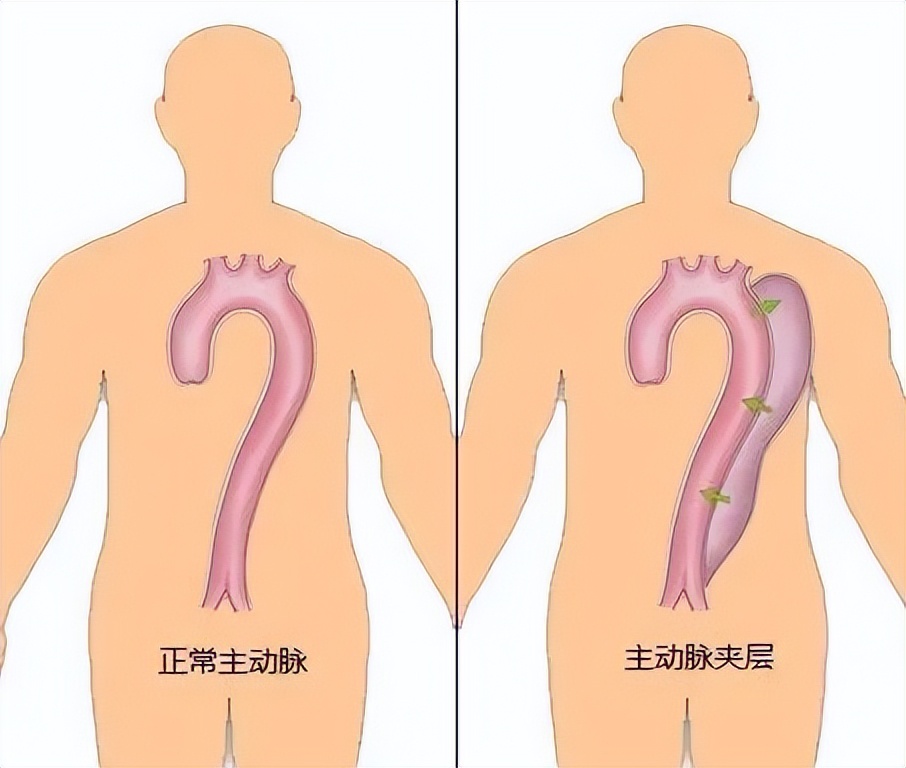 运城市中心医院主动脉夹层,主动脉夹层三甲医院都能做手术吗