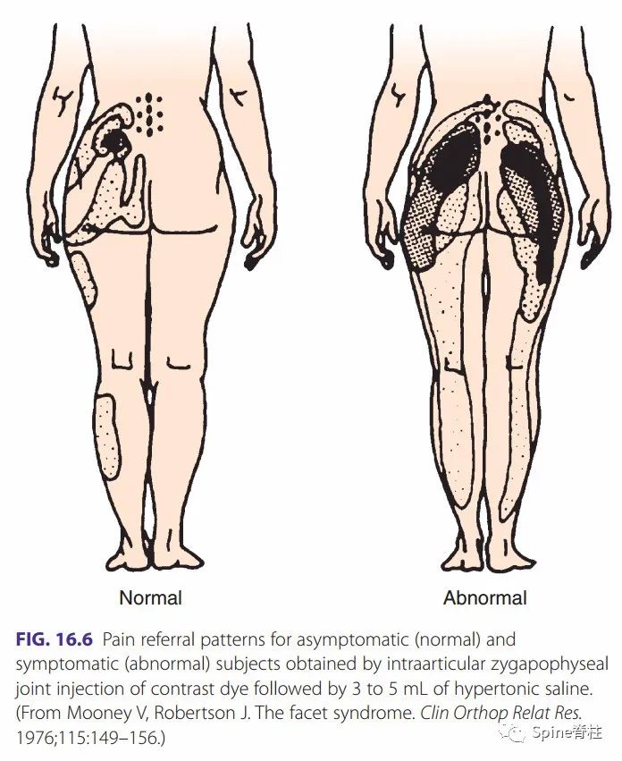 腰椎间盘突出症状表现,腰椎间盘突出症疼痛最佳止痛方法