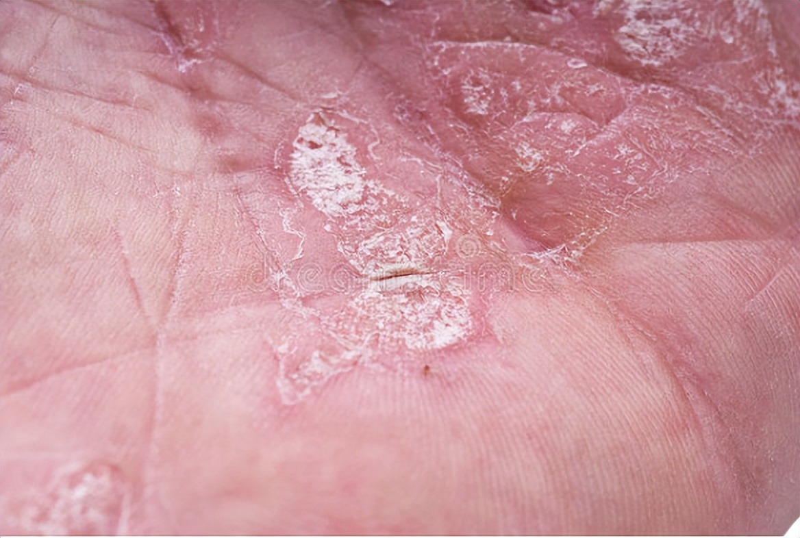 外阴癌前病变患者注意事项,得了早期外阴癌怎么办