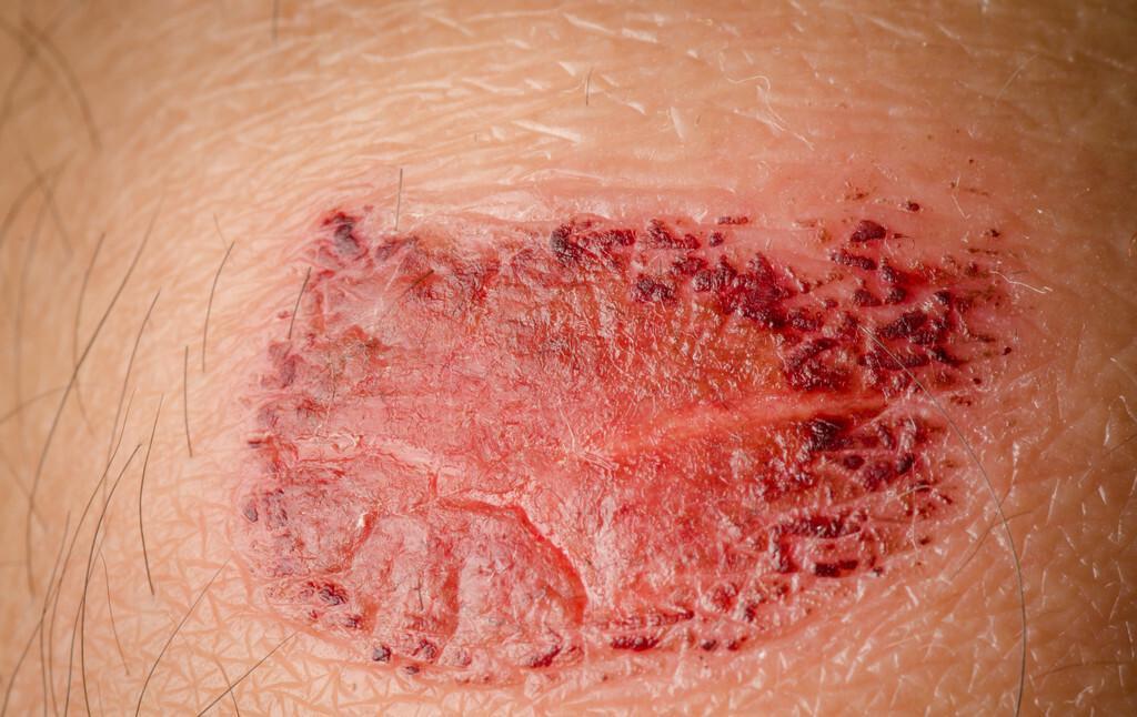 结痂的伤口，痒到怀疑人生，到底该怎么对待？看看医生怎么说