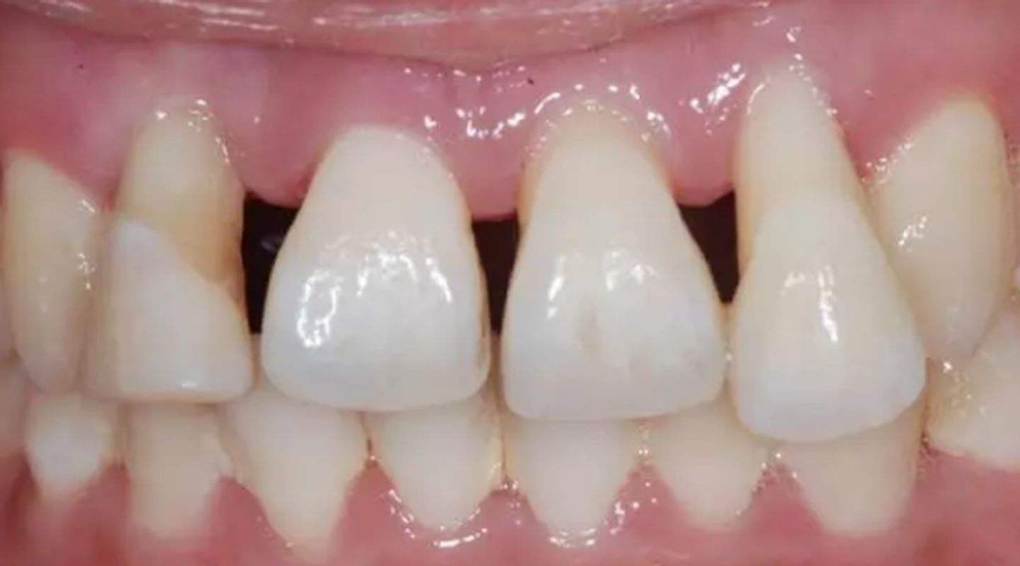 老年人大牙稀疏牙缝大怎么整,牙齿稀疏牙缝大怎么矫正老人