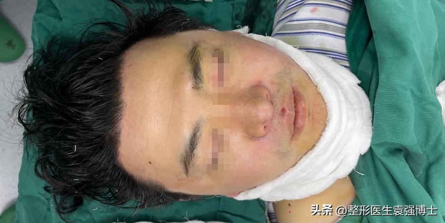 38岁小伙挑战全脸拉皮,术后逆袭帅气小哥,身边朋友不敢认