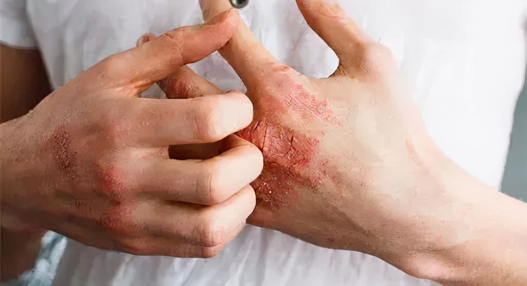 为什么手部湿疹左右对称,手部湿疹和汗疱疹的区别