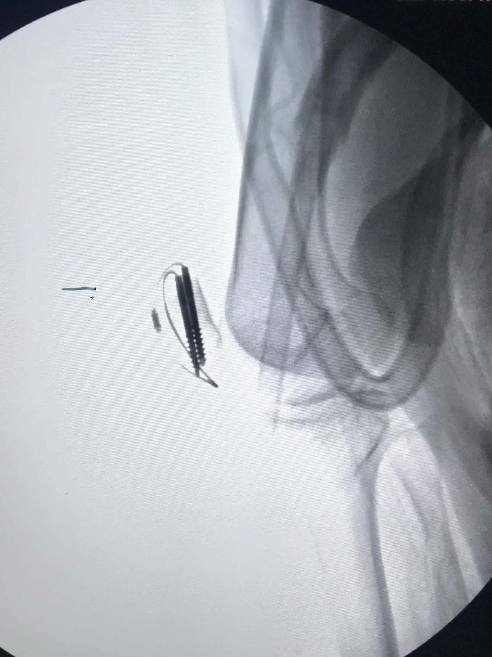 髌骨骨折的临床症状有哪些,髌骨骨折病因及发病机制