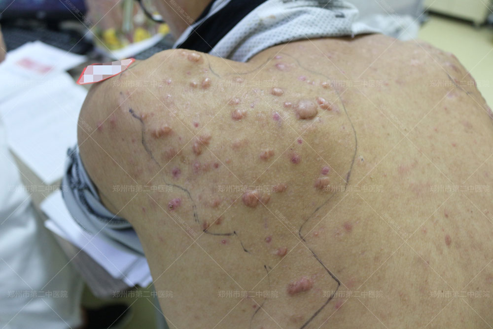 中医疤痕疙瘩怎么能彻底消除,郑州第二中医院治疤痕疙瘩有用吗