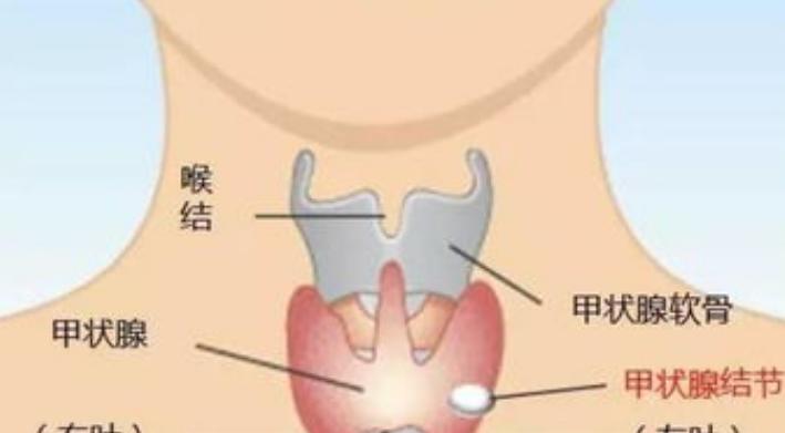 牛肉是发物甲状腺结节可以吃吗,牛肉是发物吗淋巴癌患者能吃吗
