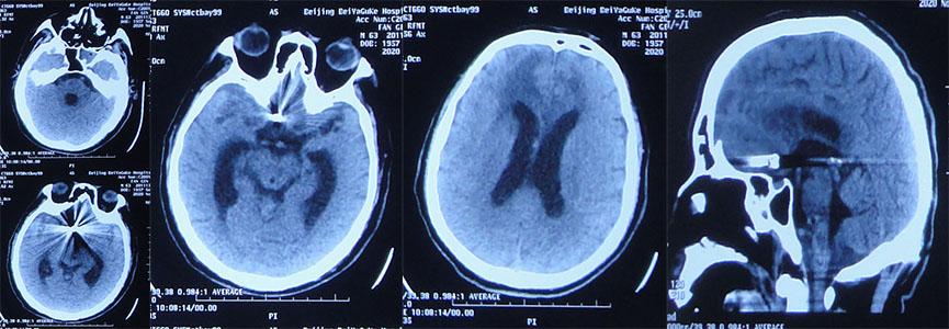 前交通动脉瘤破裂后开颅治疗风险,脑前交通动脉瘤破裂出血