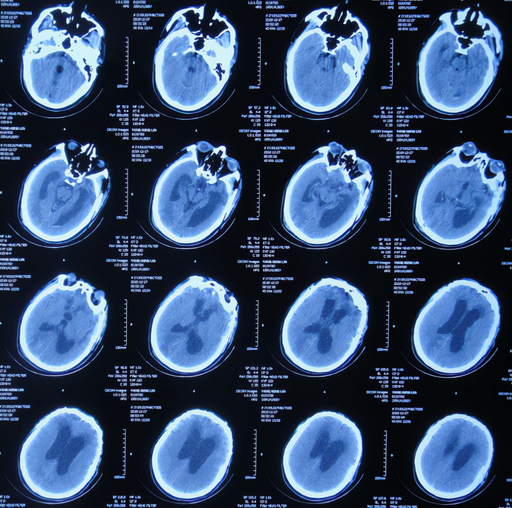 脑外伤后硬膜下积液颅骨修补,颅骨修复手术失败导致脑积水