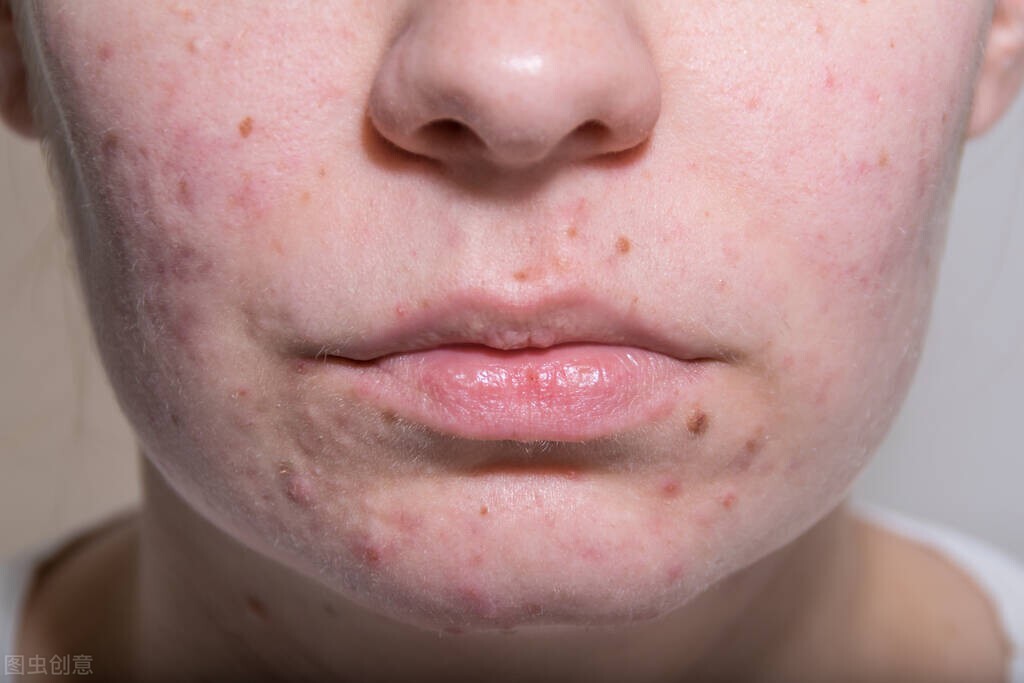 三天不洗脸，皮肤会怎么样？是越来越差，还是会越来越好