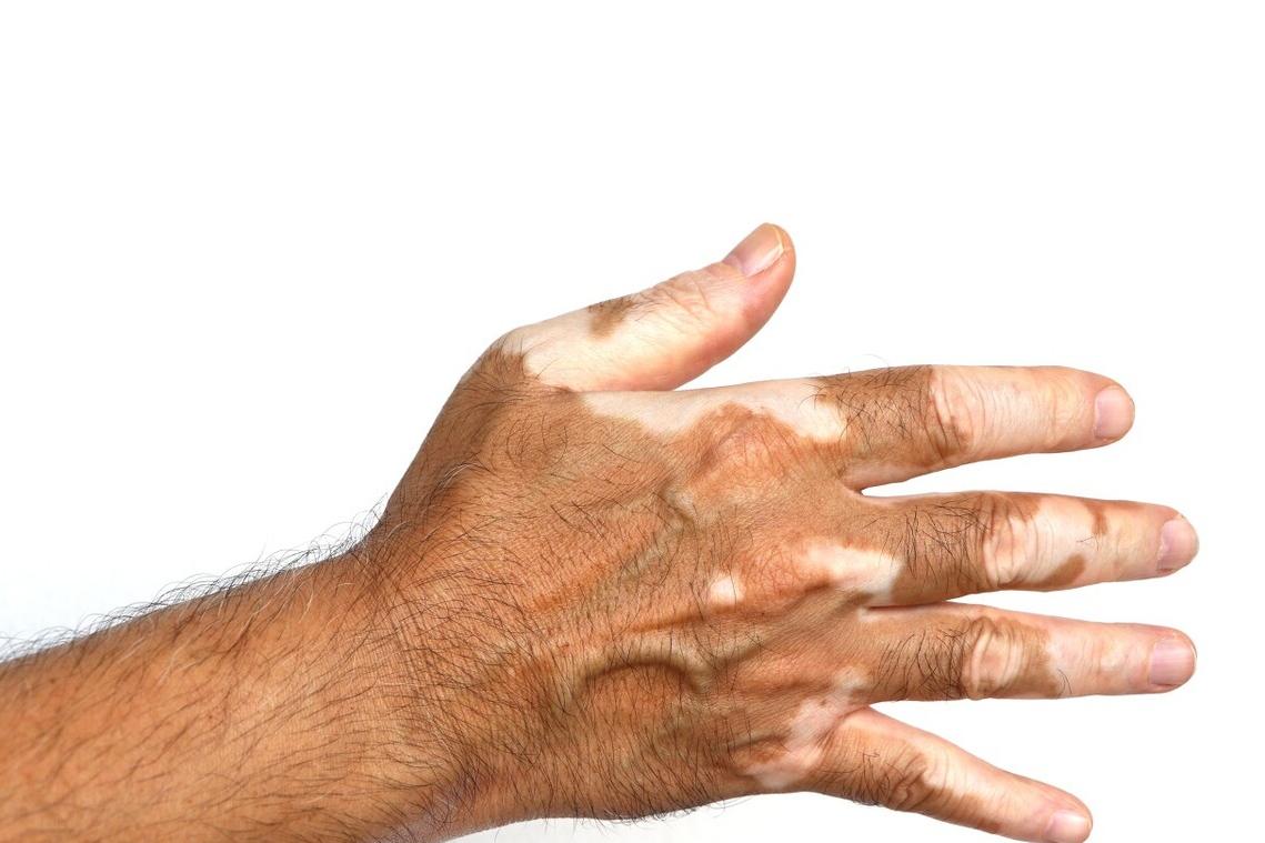 稳定期的白斑怎样快速复色,一般照几次白斑可以复色