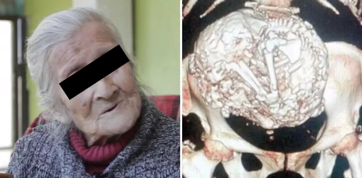 胎死腹中后孕妇有危险吗,最严重胎死腹中