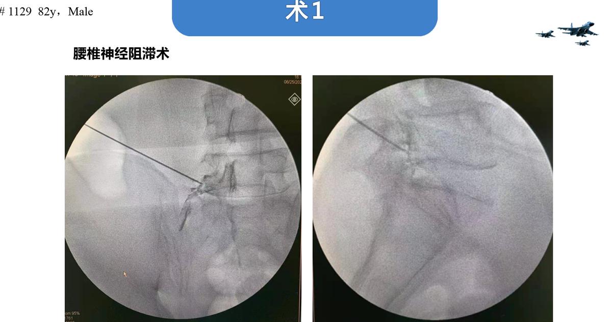老年人脊柱侧弯的危害和症状,老人脊柱侧弯腰部疼痛怎么缓解