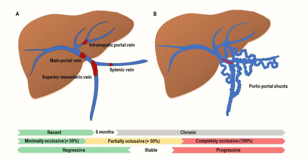 肝硬化伴有门静脉血栓介入治疗,肝硬化门脉血栓相关文章