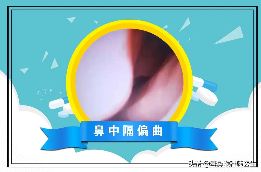 耳鼻喉电子内窥镜能检查哪些问题,硬性耳内窥镜检查疼吗