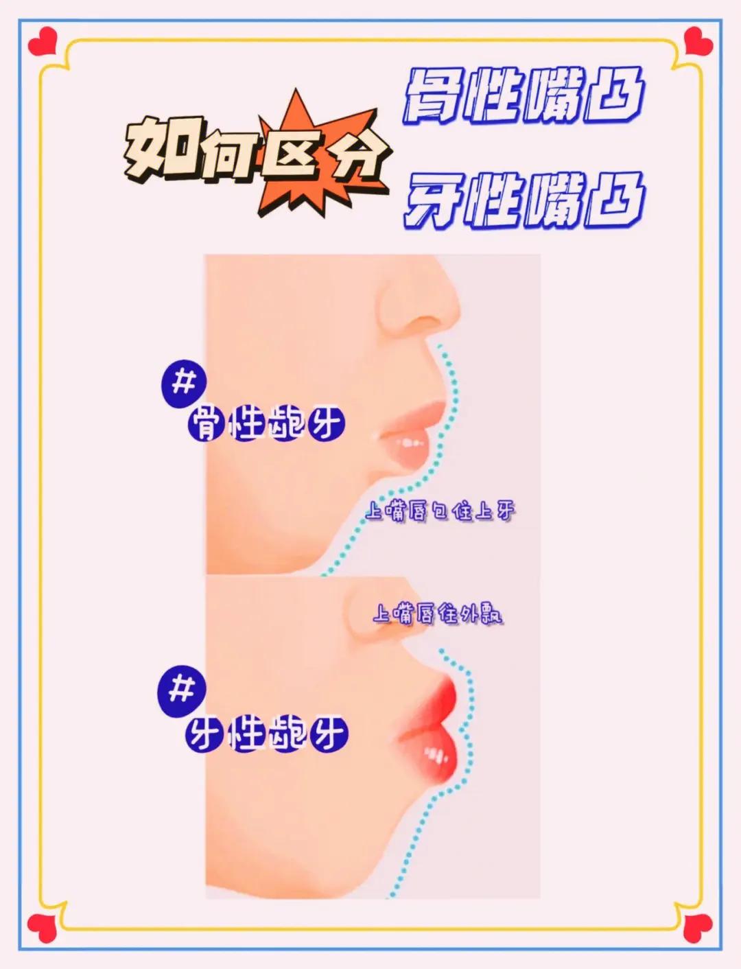 塌山根塌鼻梁怎么拯救,没山根塌鼻梁凸嘴怎么改善