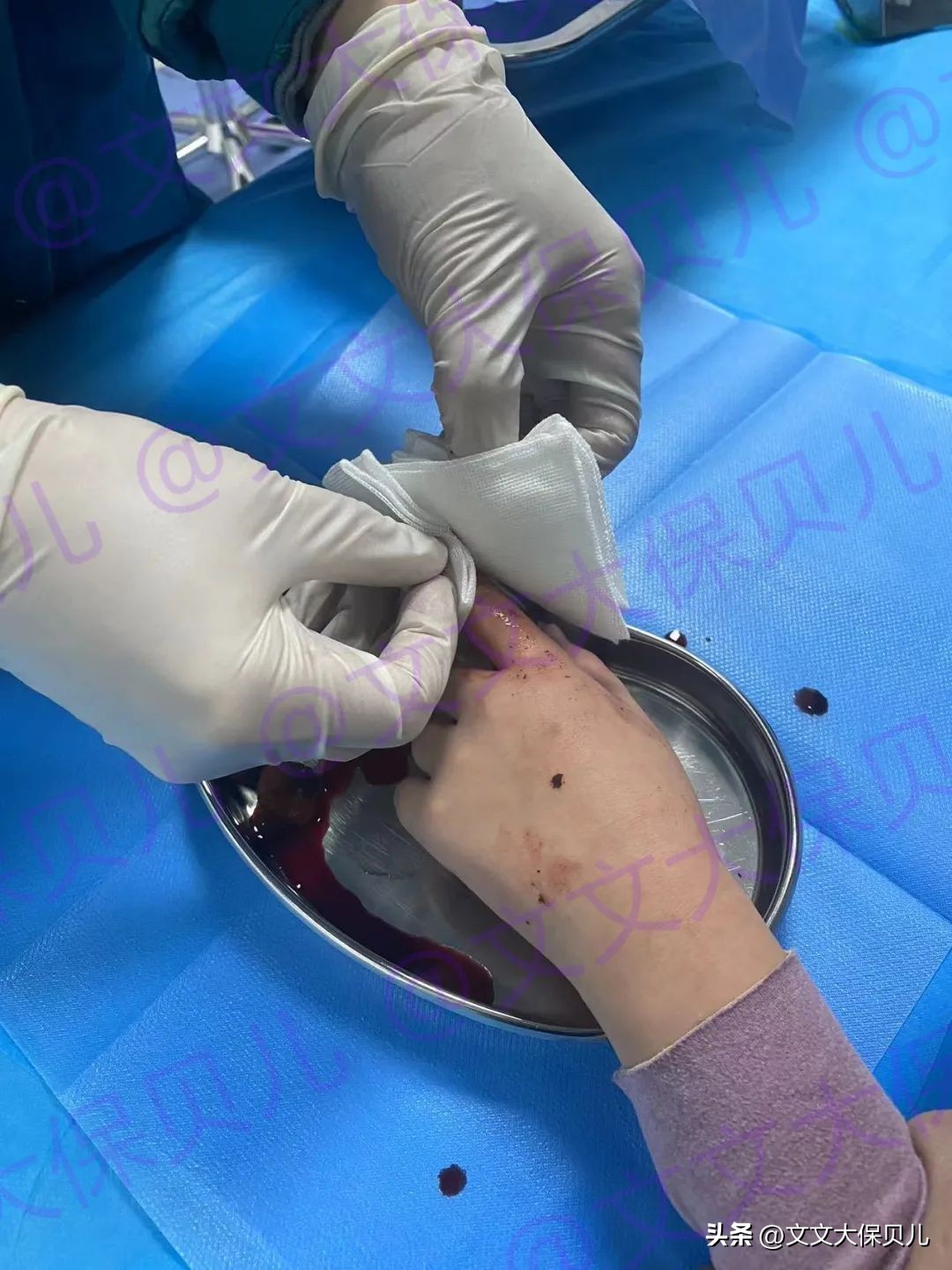 小孩子被医生操作割伤应该赔偿吗,儿童被意外划伤怎么理赔