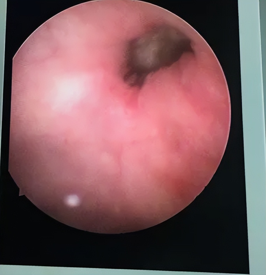 阿莫西林跟头孢是抗生素吗,阿莫西林和头孢哪一种消炎好