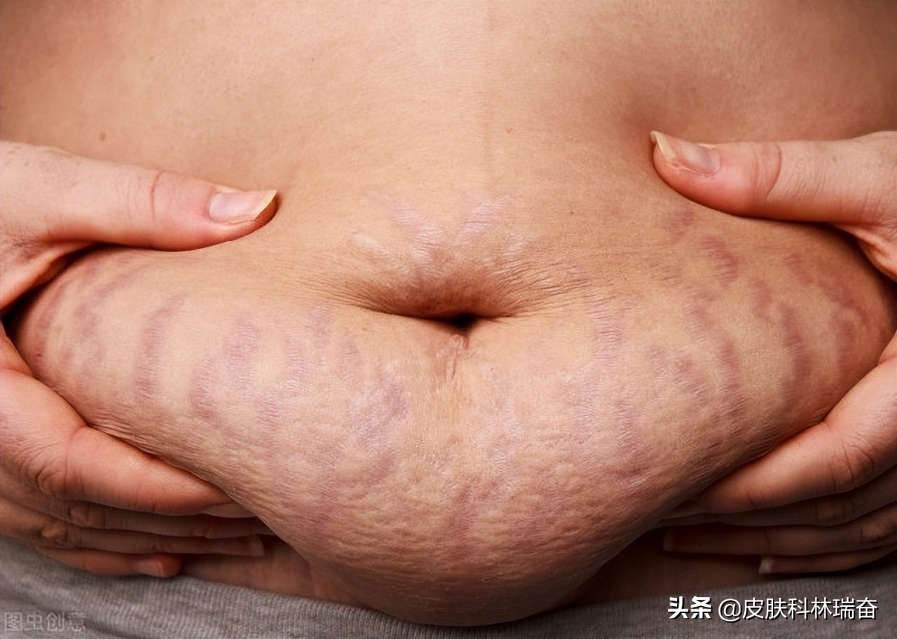 8种消除疤痕的自然方法,处理疤痕最好的方法