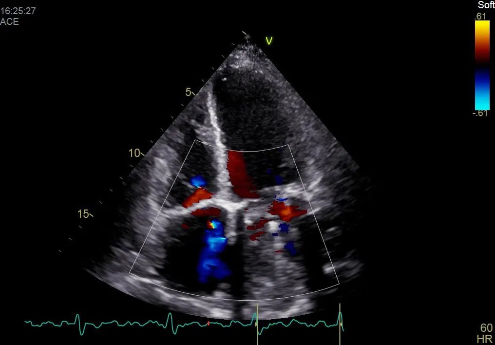 10岁女孩心脏有杂音是怎么回事,她的心脏