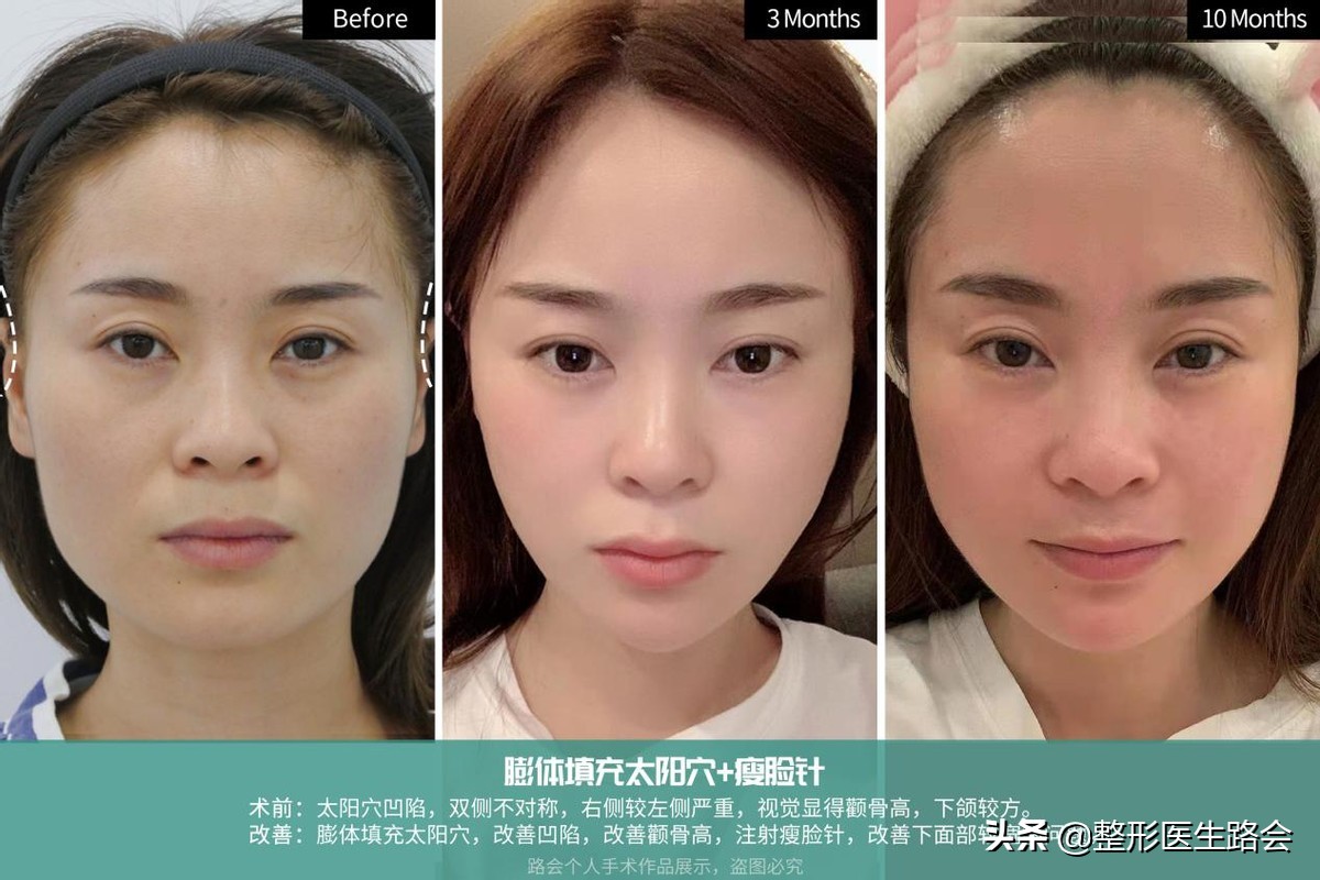 除皱针十问十答,去皱针10问