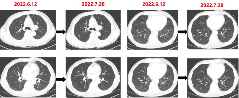 中国国内结直肠癌最新治疗,结直肠癌治好的可能性大吗