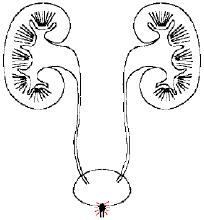 输尿管结石有什么好的治疗方法,得了输尿管结石用什么方法治疗