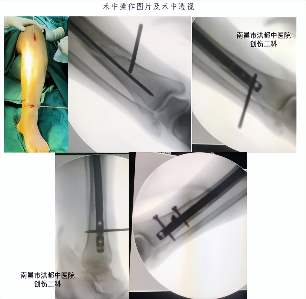 女子滑倒致小腿骨折，医生巧术让患者“快速复位”