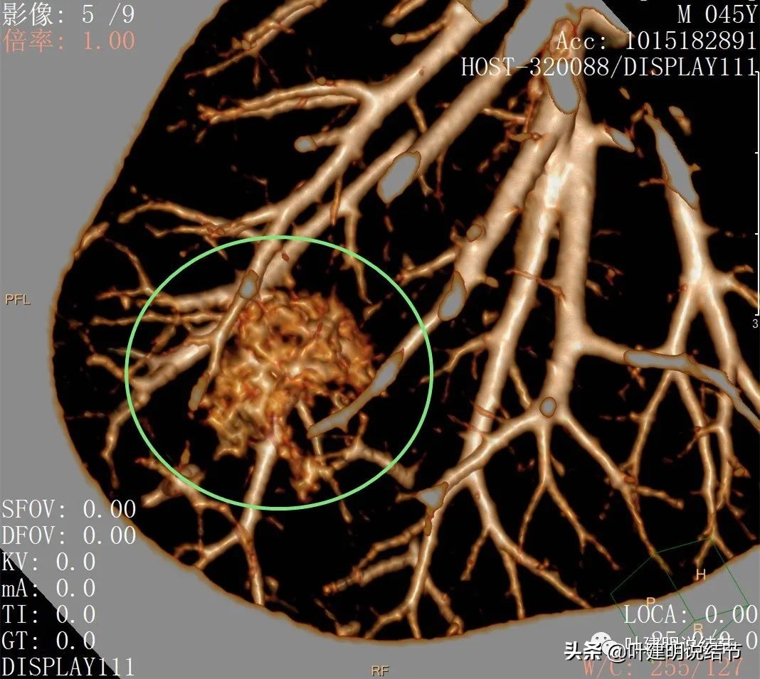 肺蜂窝状改变是肺癌吗,肺部陈旧灶与肿瘤怎么确诊