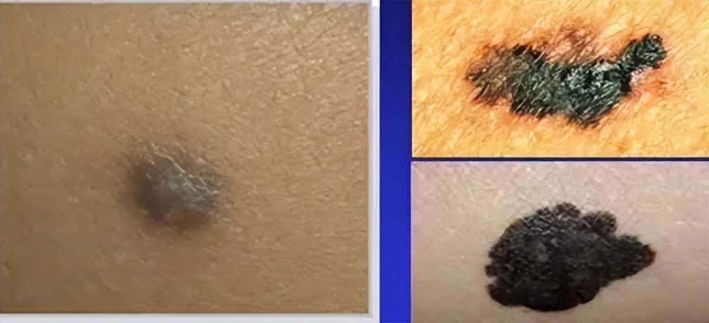 男子长了1000个鸡眼,58岁男性脚底长了一个包一碰就疼