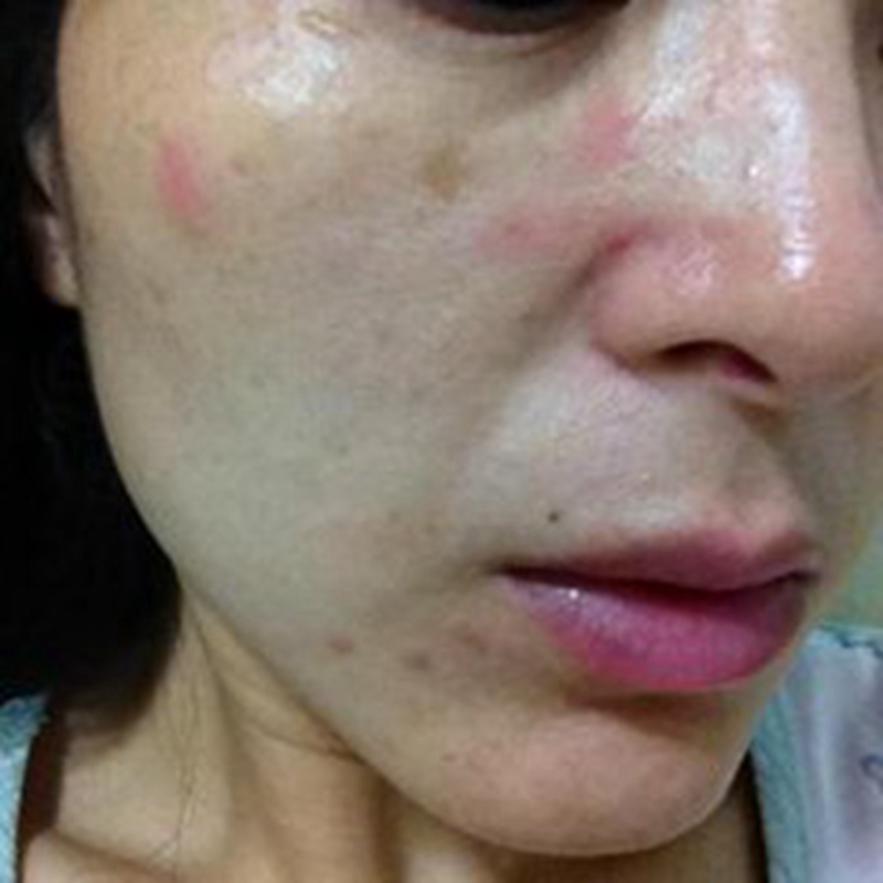 皮肤疾病科普,头皮脂溢性皮炎用什么药